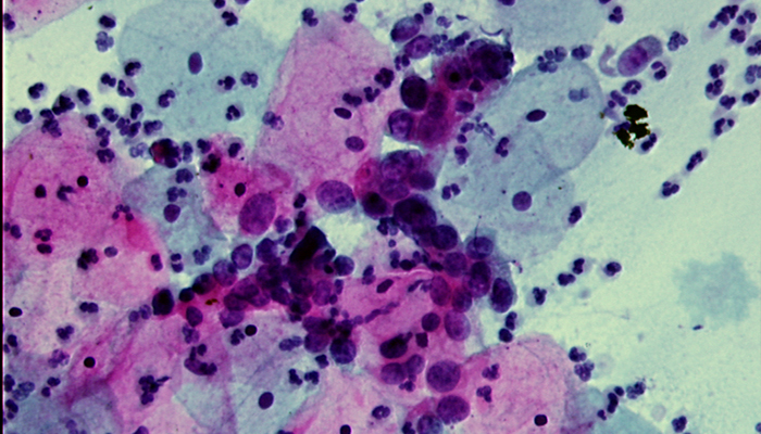 Zytologie Susp-Endoc-Zellen B 40x - Pathologie Schleswig-Holstein